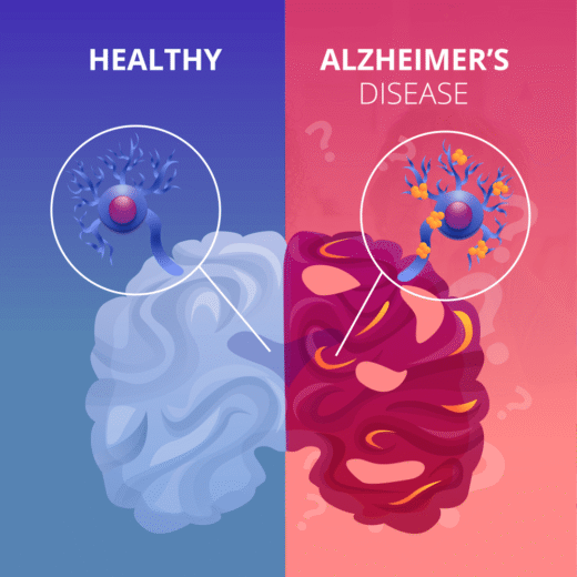 آلزایمر Alzheimer's disease